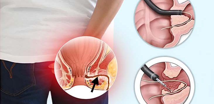 FISTULA.jpg (1)