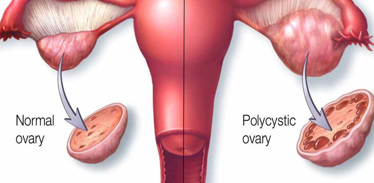 PCOD.jpg (1)